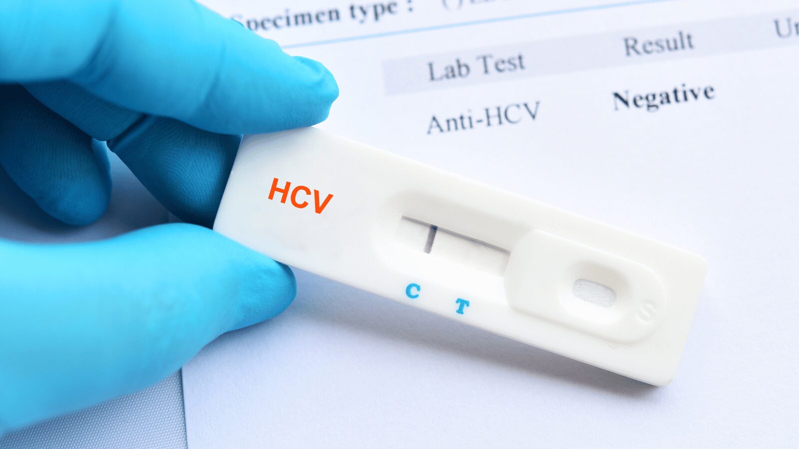 A gloved hand holding an HCV test device showing a single line indicating a negative result. The background shows a lab test form for Anti-HCV.